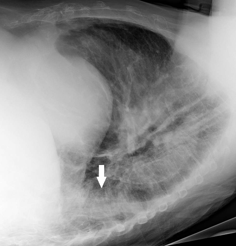 Chest radiograph